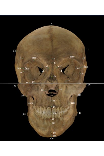 Craniometric landmarks on a skull 3D model frontal position